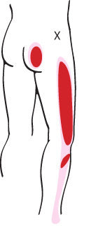 The Bum Wrap: Therapeutic Relief For Sciatic Pain